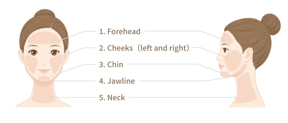 Explanation of treatment areas for acne